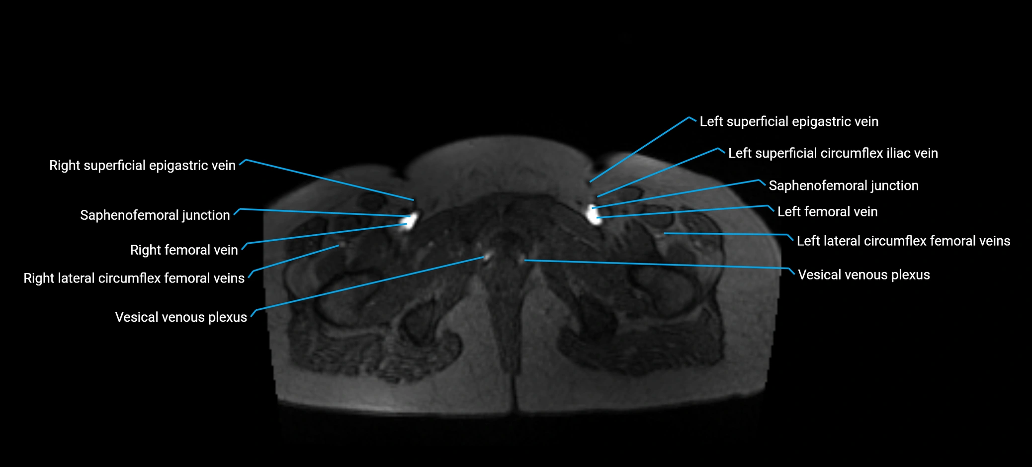 MRV abdomen pelvis & lower limb axial cross sectional anatomy labelled MRI image 193 (1).webp